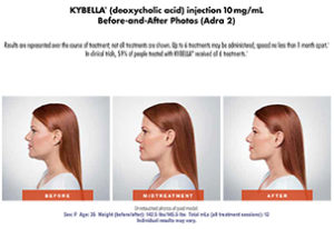 Kybella for Double Chin Ladera Ranch