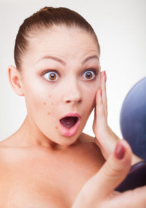 Acne in women Ladera Ranch