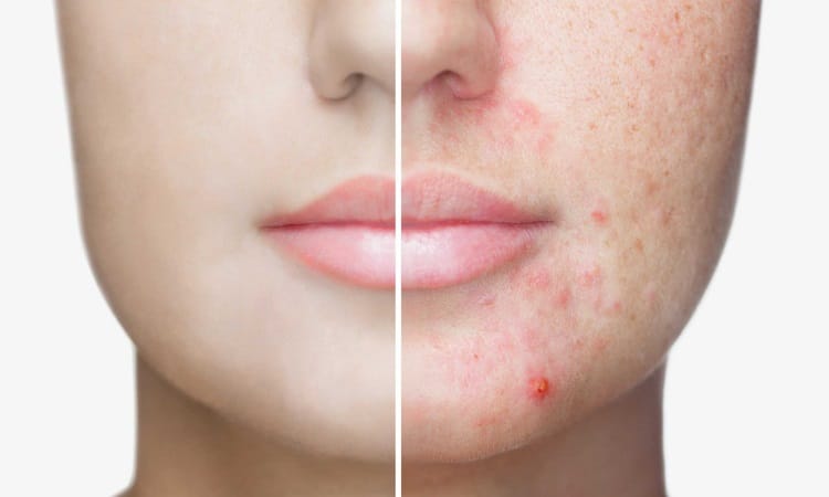 Acne Treatments Ladera Ranch