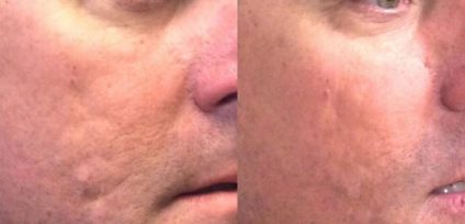 Venus Viva Ladera Ranch | Laser Skin Resurfaicng Orange County