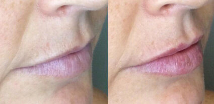 Lip Fillers Case Ladera Ranch