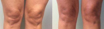 Venus Legacy Body Contouring Cellulite Reduction Ladera Ranch